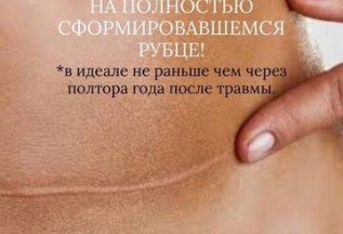 Камуфляж растяжек, рубцов, шрамов. Без боли!!!