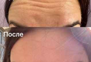 Коррекция верхней трети лица Диспорт (ботулинотеропия)