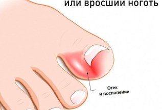 Нужны модели с вросшим ногтем