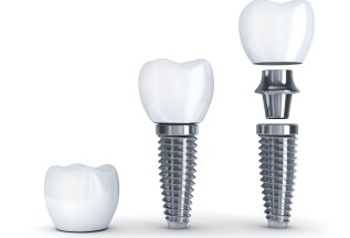 Имплантация Dentium (Южная Корея) 24900 руб.