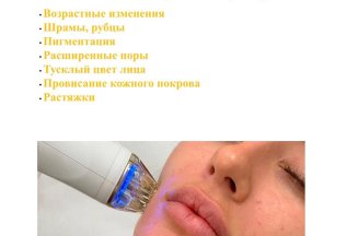 Микроигольчатый RF -лифтинг на аппарате FACE SCULPT