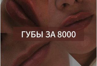 Увеличение губ за 8000
