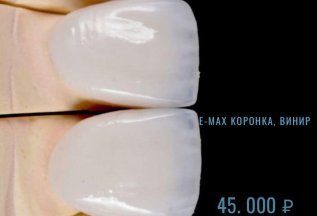 E - Max коронка, винир за 33800 ₽