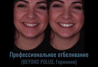 Профессиональное отбеливание