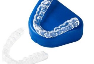 Детские элайнеры Flexiligner под ключ на две челюсти