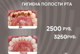 АКЦИЯ! Профессиональная гигиена полости рта за 2 500 руб!