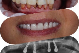 Установка зубов за один день на 4-х имплантах MIS (США)