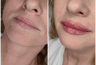 Коррекция губ, скул, носа, подбородка филлерами - 20%