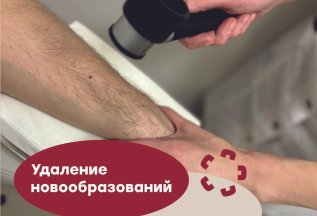 Удаление новообразований на коже, прием онколога за 1 рубль