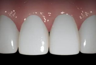 Восстановление утраченного зуба за одно посещение 13000 руб.