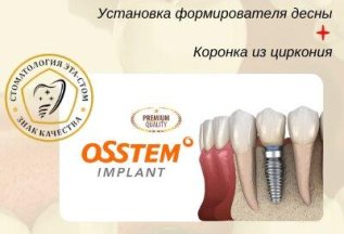 Акция на установку имплантатов OSSTEM “под ключ”