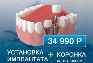 Установка имплантата + коронка - 34990 руб!