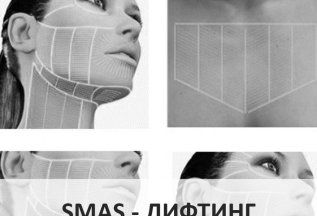 SMAS-лифтинг (лицо, шея, декольте)