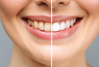 Профгигиена зубов — 5 500 ₽