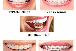 Ортодонтическое долечивание на брекетах