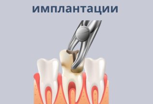 Удаление зуба бесплатно, при одномоментной имплантации
