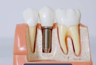 Имплантация зубов All-on-4 «Osstem» (Южная Корея) - 132 000