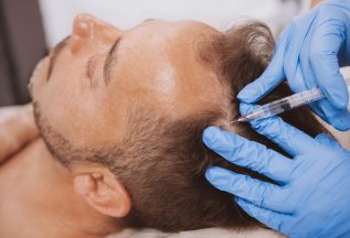 PRP терапия, лечение волос