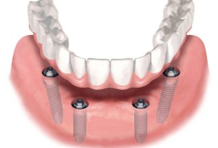 ВОССТАНОВЛЕНИЕ ЗУБОВ ПО СИСТЕМЕ «ALL-ON-4» 261 000