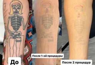 Лазерное удаление татуировок и татуажа -30%