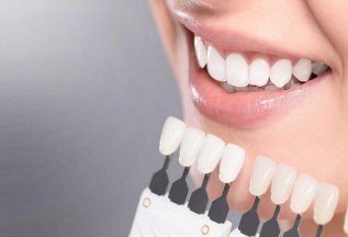 Отбеливание зубов 2 челюсти для 2 пациентов 30 000 руб.