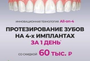 Протезирование зубов на 4-х имплантах за 1 день