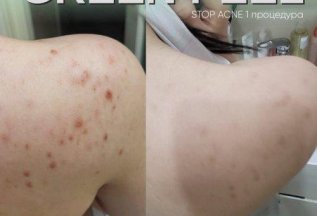 GREEN PEEL® STOP ACNE 6000₽