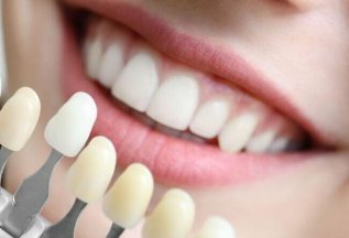 Экспресс отбеливание по системе Amazing White за 4000 руб