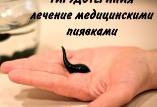Больно ли ставить пиявок?