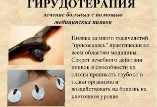 ГИРУДОТЕРАПИЯ — УНИКАЛЬНЫЙ МЕТОД ЛЕЧЕНИЯ