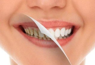 Гигиена полости рта и зубов для взрослых по специальной цене