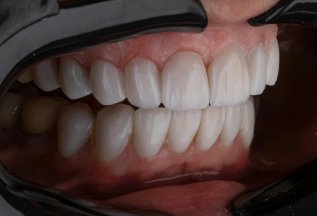 Зубы на один день, концепция на 4 имплантатах