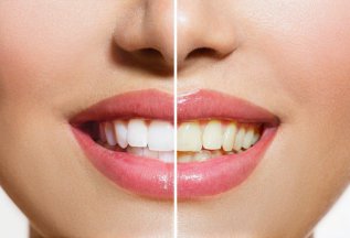 Отбеливание зубов по системе Opalescence Boost