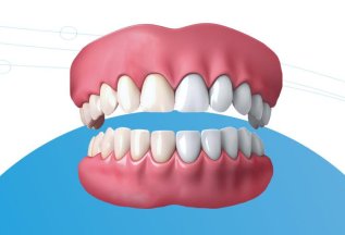 Отбеливание зубов со скидкой 10%