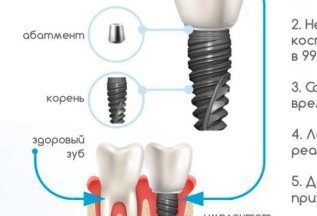 Бесшовная имплантация под ключ с коронкой за 49000 рублей!