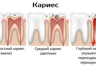ЛЕЧЕНИЕ КАРИЕСА от 3000 р