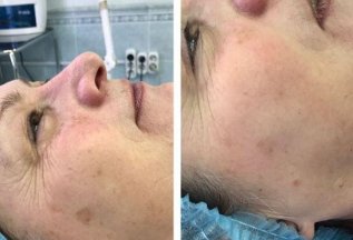Работа с пигментацией