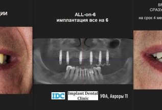 All-on-4 и All-on-6 протезирование без переплат