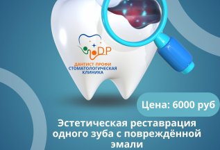 Эстетическая реставрация одного зуба с повреждённой эмали