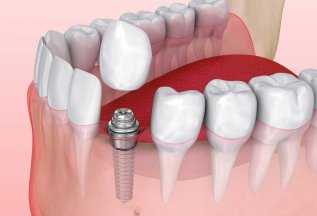 Осенняя акция - имплантация 25 000 руб.