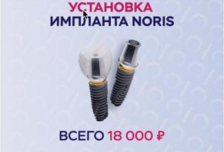 Установка импланта Noris Medical (Израиль) - 18000 руб.