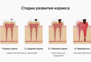 Лечение кариеса