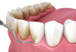 Пародонтологическая чистка 8000 руб.