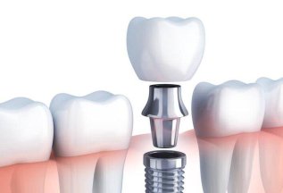 -20% на Циркониевую коронку на импланте - 35400 руб.