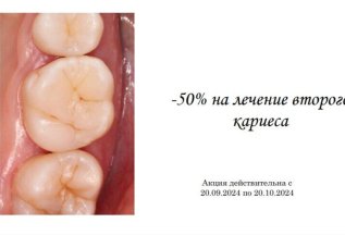 -50% на лечение второго кариеса