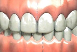 Неправильный прикус: когда улыбка требует внимания?