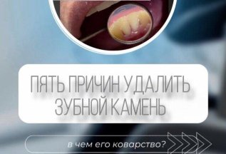 «Пять причин», что зубной камень вам не нужен✖️