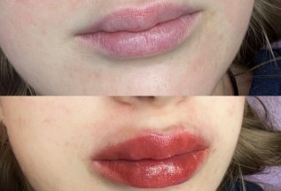 Увеличение губ от 8000₽ 💋