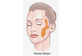 Удаление комков Биша-50 000₽