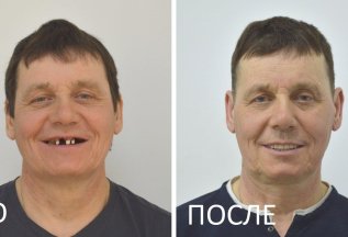 При установке виниров - 8-й Бесплатно!